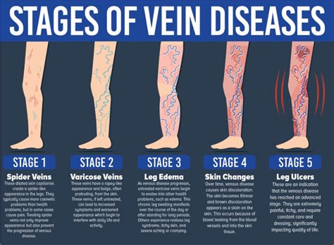 Venous Ulcers - Ivein Clinic