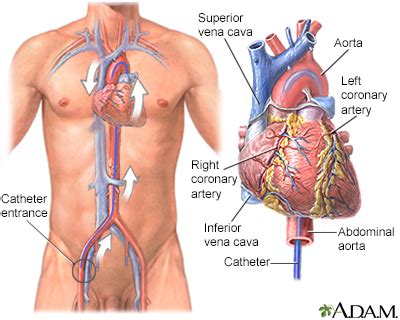 Cardiac catheterization Information | Mount Sinai - New York