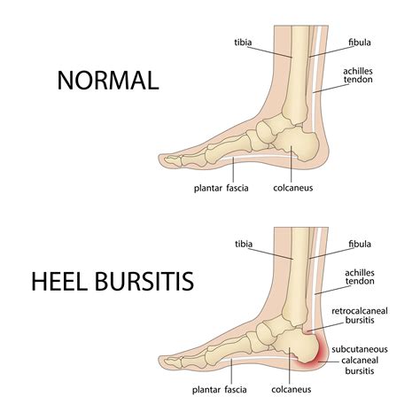 Calcaneal bursitis. Foot with normal heel and foot with Haglund's ...