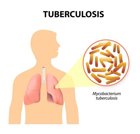 What you know about Tuberculosis (TB)? , How is it treated?