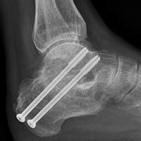 Subtalar Joint Arthritis - Arthrodesis | Stirling | Nedlands