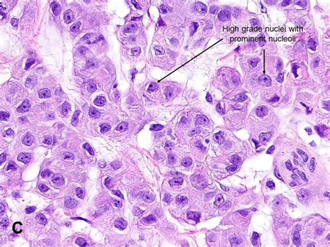 American Urological Association - Malignant Mesothelioma (MM)