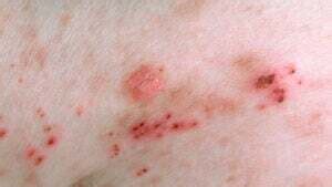 Kidney Disease Rash: Pictures, Symptoms, Causes, and Treatments