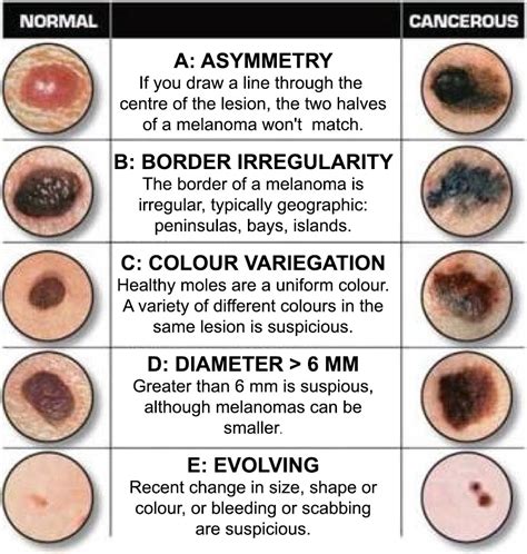 How Curable Is Melanoma Skin Cancer - CancerWalls