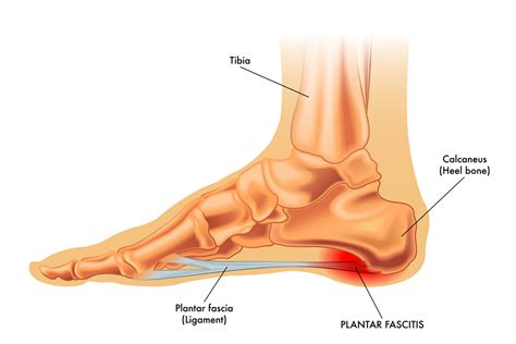 PLANTAR FASCIITIS EXERCISES TO RELIEVE YOUR HEEL PAIN | Foot & Podiatry ...