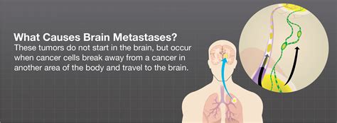 What Causes Brain Metastases? - Brainlab.org