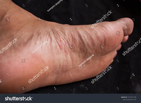 Skin Fungus Foot Foot Disease Stock Photo 1015971790 | Shutterstock