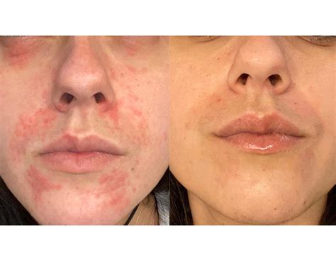 Effective Perioral Dermatitis Treatments Brisbane - Cutis Dermatology