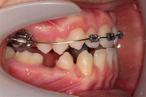 Anterior crossbite correction as an alternative method - Dentistry