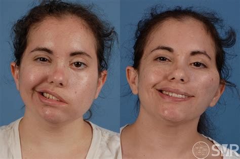 Facial Paralysis After Surgery Before and After Photo Gallery | Dallas ...