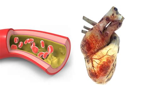 The Link Between Diabetes and Heart Disease - Alternative Medicine Magazine