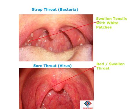 Ultimate Guide To Combat Warning Signs Of Strep Throat