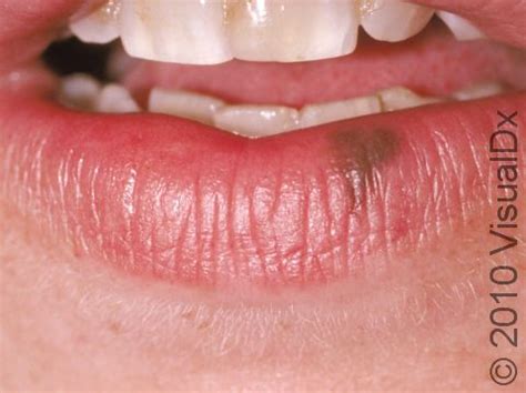 Oral Melanotic Macule: Symptoms and Treatment - Skinsight