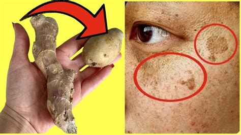 How to Remove Dark Spots on Face with Potatoes and Ginger