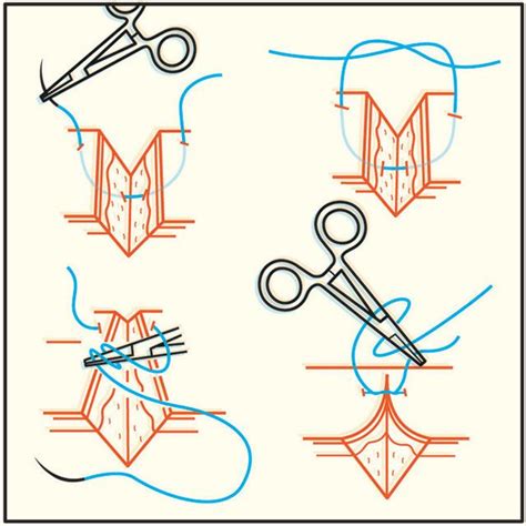 How to Stitch a Wound | Emergency medicine, Emergency medical, First ...