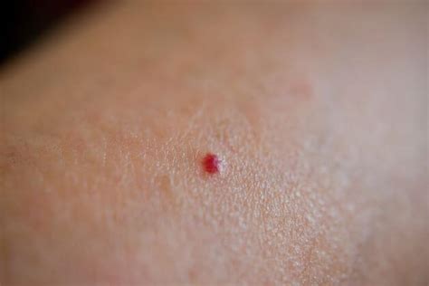 Cherry Angioma | Removal, Causes, Treatment, and Pictures