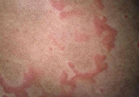 Chronic skin rashes that itch - jokerperks