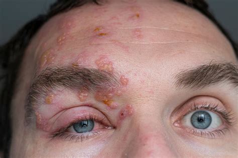 Shingles on the Face: Symptoms, Causes, and Treatments | MyVision.org