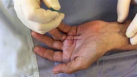 Dupuytren's contracture new treatment, minimally invasive needle ...