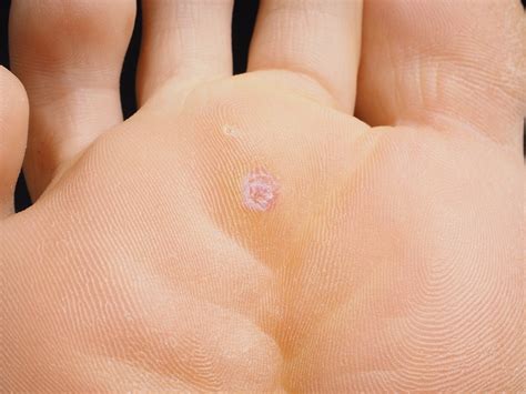 The Causes, Symptoms and Treatment of Plantar Warts