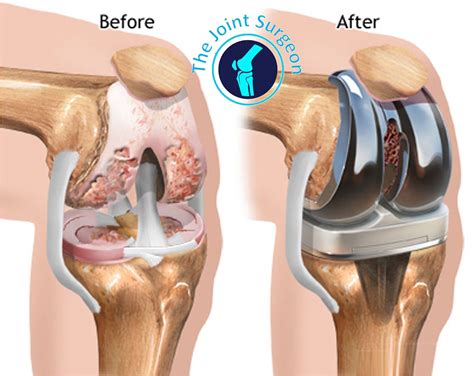 Is Knee Replacement Surgery Common Knee Replacement | Hot Sex Picture