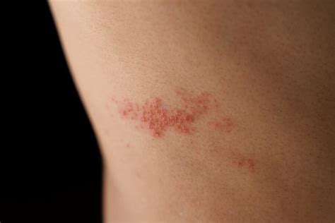 Shingles Symptoms No Rash Treatment - Infoupdate.org