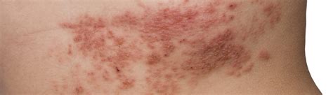 What are Shingles? (With Pictures) -HealthScope