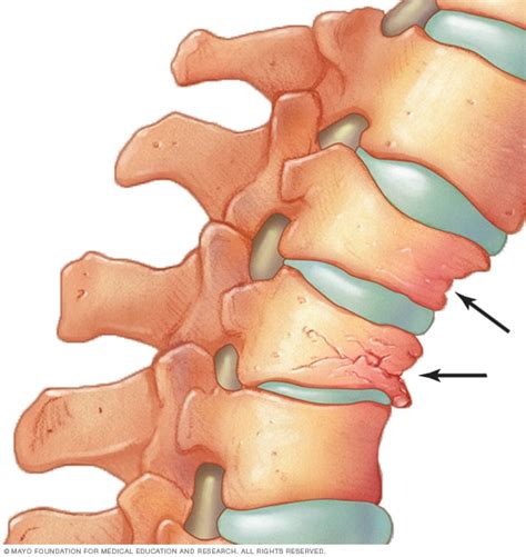 Osteoporosis - Symptoms and causes (2022)