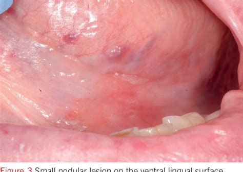 Figure 1 from The early diagnosis of small-sized oral squamous cell ...