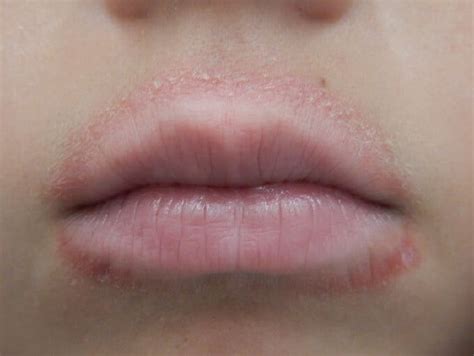 Dry Scaly Patch On Lips | Lipstutorial.org