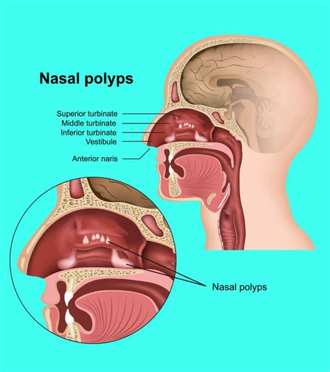 Nasal Polyps In Children: Signs, Causes, Risks, And Treatment