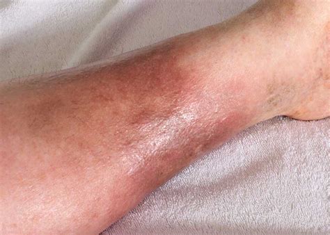 Cellulitis Treatment | Dermatology, Inc.