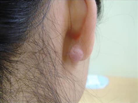 Keloid on ear: Causes, treatment, and prevention