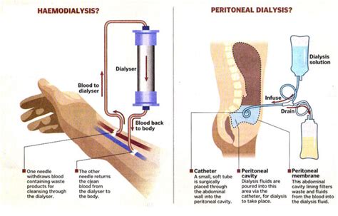 What is the procedure for dialysis?