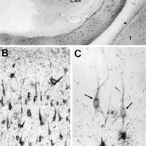 (PDF) Neurofibrillary Tangles and Alzheimer’s Disease