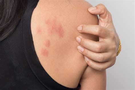 Stress Rash: What It Is, How to Treat and Prevent - Pharmacists.org