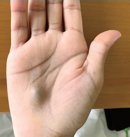 This Bulging Lump on a Man's Hand Revealed a Serious Heart Infection ...