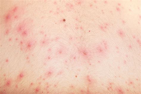 Chicken Pox Symptoms In Adults Pictures - Mahilanya