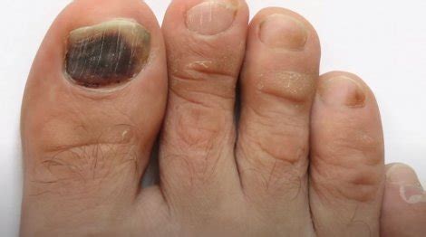 Black Toenail Fungus: Causes, Treatments, And More | Nail Care Hub