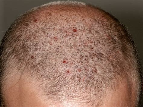 Bumps on the scalp: Causes, symptoms, and treatments