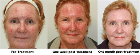 Daylight Photodynamic Therapy – A New Way to Treat Sun Damage ...