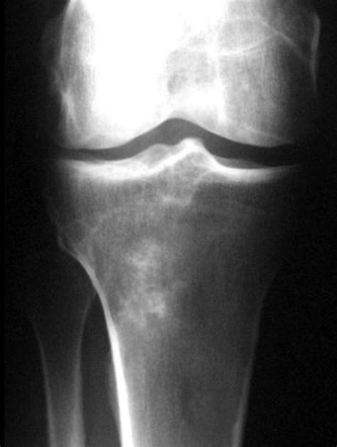 Chondrosarcoma x ray - wikidoc