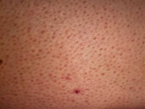 Skin Keratosis Pilaris