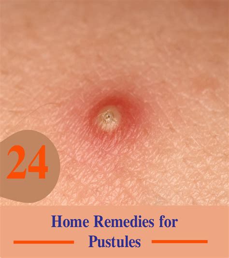 24 Home Remedies for Pustules - PromoHealthy