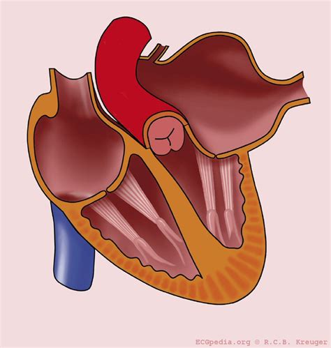 File:Left atrial enlargement.jpg - ECGpedia