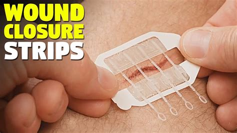 Zip Stitch: Easy wound closure strips eliminate the need for stitches