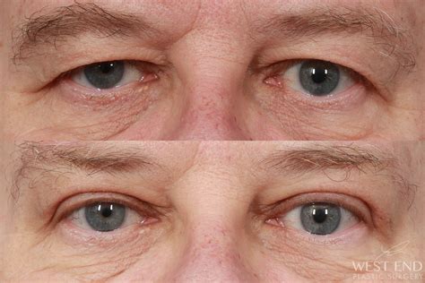 Upper Eyelid Lift & Brow Lift (2 weeks post-op) Case 10348 - West End ...