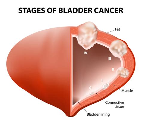 Urologic Cancer: Types, Symptoms, Stages, Diagnosis & Treatments