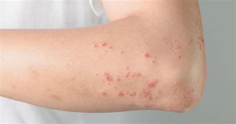 Itchy Rash And Bumps On Elbows | Images and Photos finder