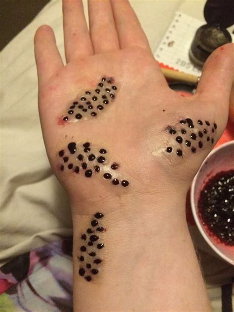 Trypophobia Skin Disease Hand